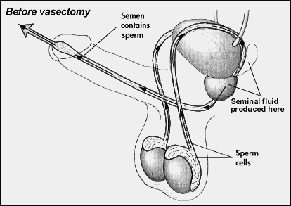before vasectomy